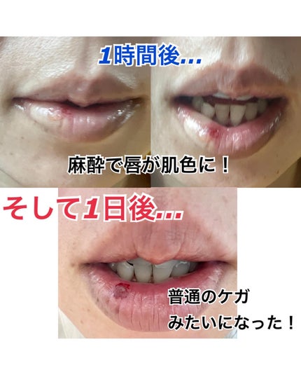 のんたん旅うさぎ on LIPS 「★唇🫦のホクロを取ったハナシ★最近、yamate_hifuka..」(2枚目)