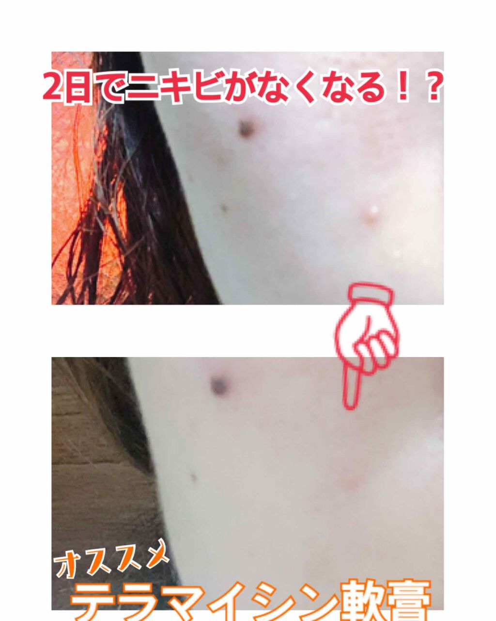 テラマイシン 軟膏(医薬品)/ジョンソン・エンド・ジョンソン/その他を使ったクチコミ(1枚目)