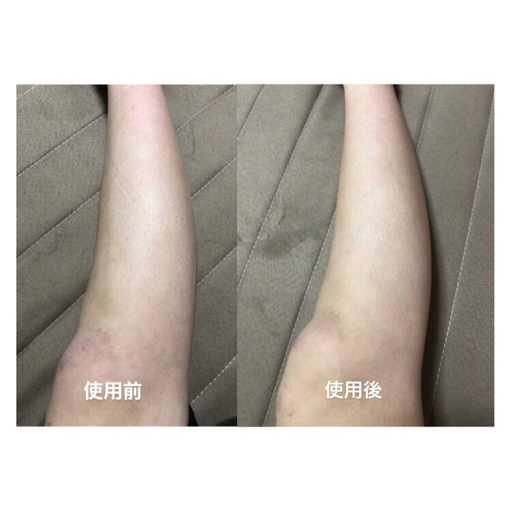 ケアノキュア（医薬品）/小林製薬/その他を使ったクチコミ（2枚目）