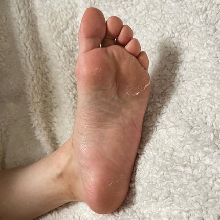 イージーパックDP60分タイプ/ベビーフット/レッグ・フットケアを使ったクチコミ(6枚目)