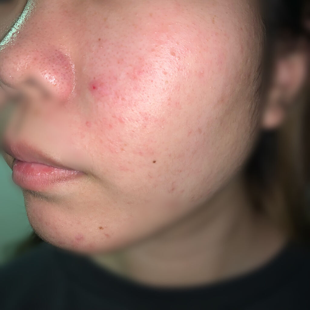 Oxy ディープウォッシュ/OXY (ロート製薬)/洗顔フォームを使ったクチコミ（2枚目）