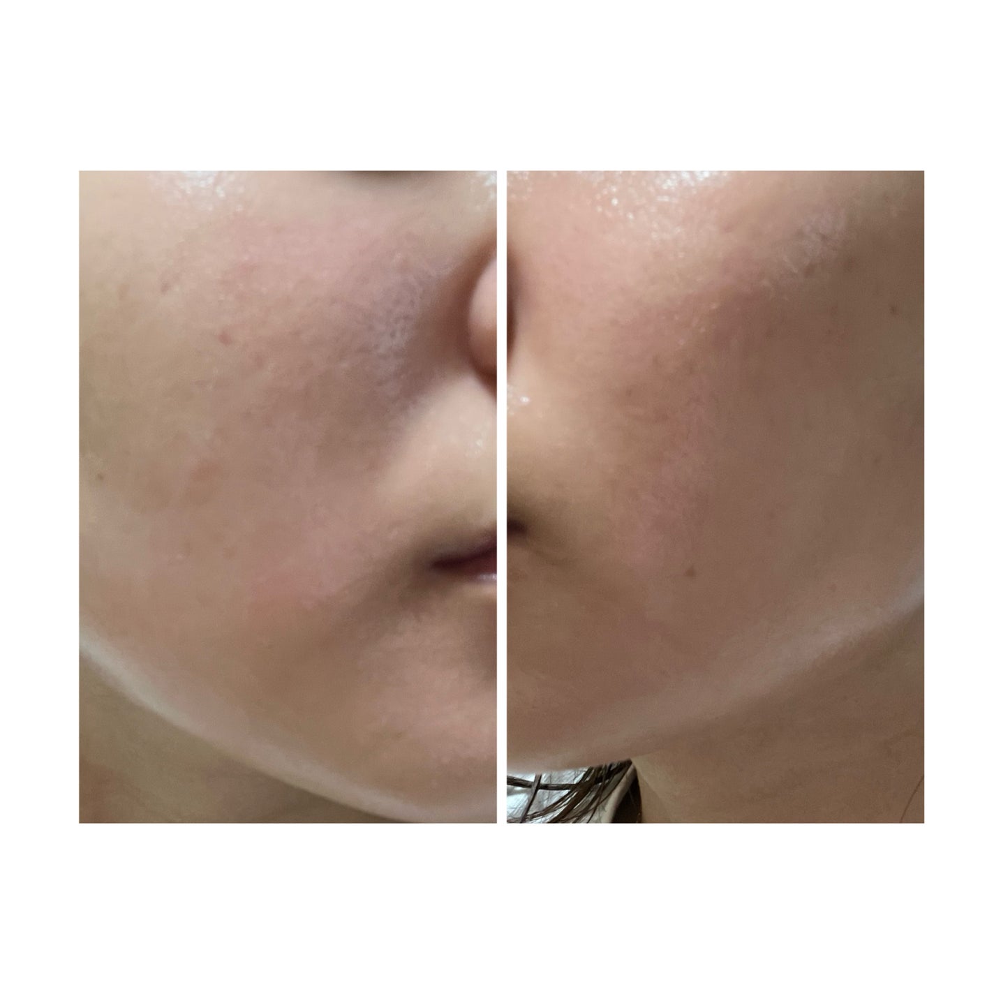 ぽむ on LIPS 「2023.9.13皮膚科に受診 エピデュオとヘパリン処方1枚目..」(4枚目)