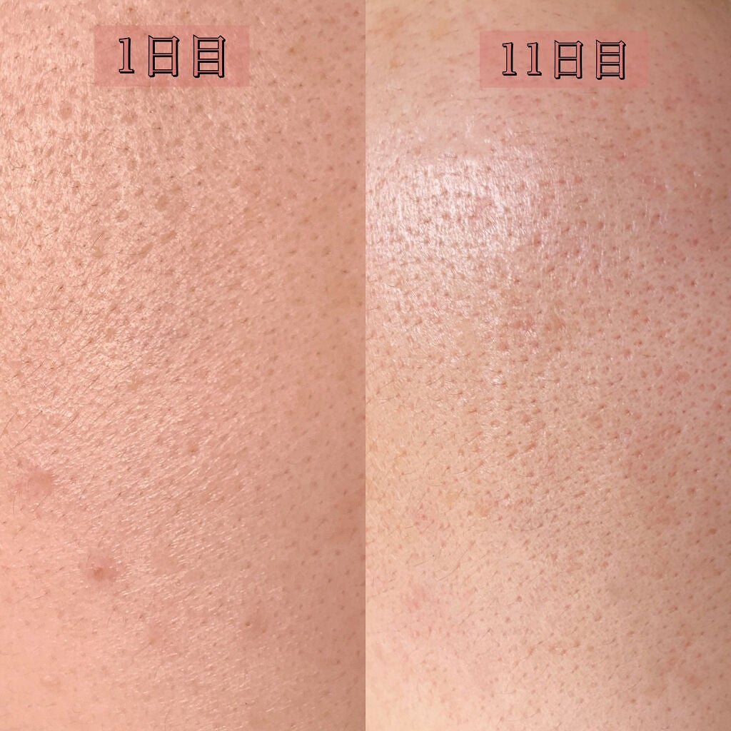 ピンクティーツリートナー/APLIN/化粧水を使ったクチコミ(8枚目)