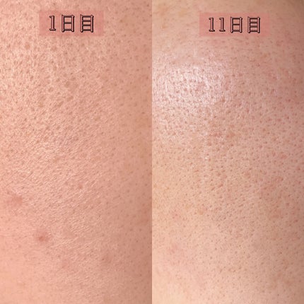 ピンクティーツリートナー/APLIN/化粧水を使ったクチコミ(8枚目)