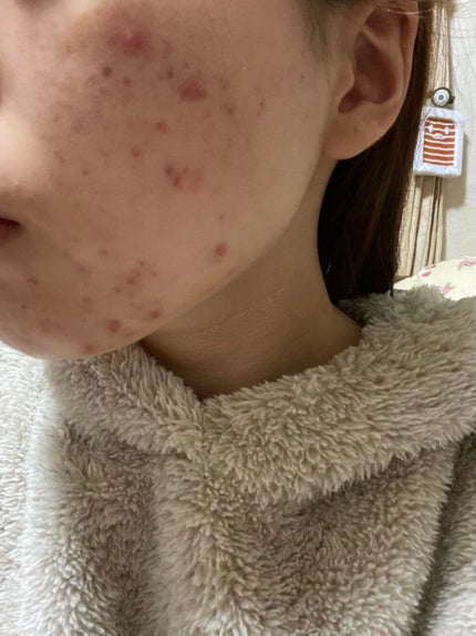 モイスチャー リッチローション(とてもしっとり)/アルージェ/化粧水を使ったクチコミ(3枚目)