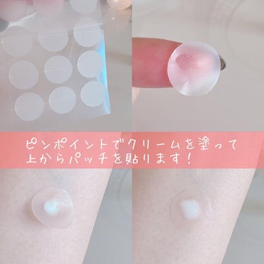 薬用 美白アクネホワイトクリーム 専用パッチ付/アクネスラボ/にきびパッチを使ったクチコミ（3枚目）