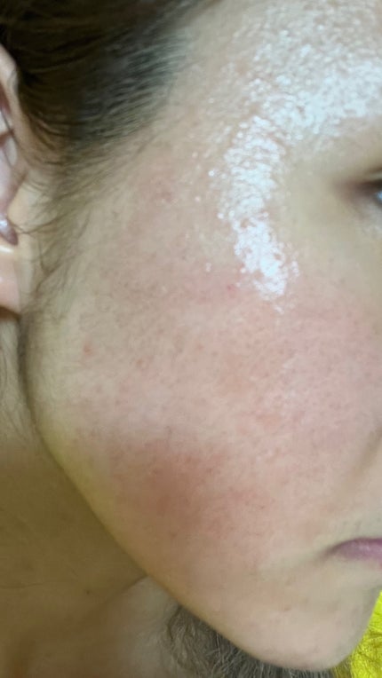 あーちゃん on LIPS 「初投稿失礼します🙇♀️あーちゃんです!!私の肌歴史を紹介しま..」(4枚目)