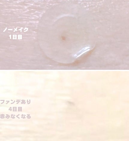 ノスカナイン スポット パッチ/FATION/にきびパッチを使ったクチコミ(6枚目)