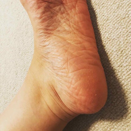 足用集中保湿パック/ドクター・ショール/レッグ・フットケアを使ったクチコミ(5枚目)