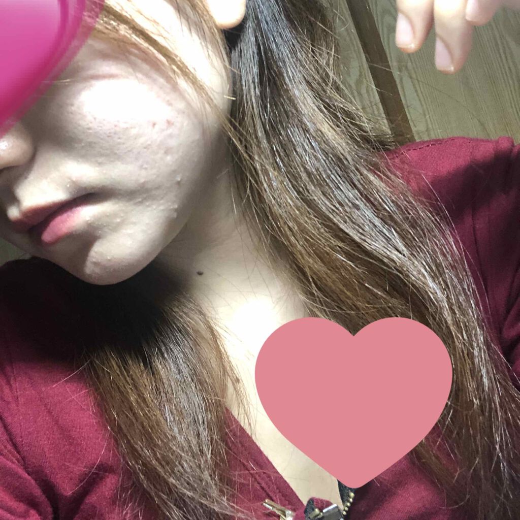 ペアアクネクリームW(医薬品)/ペア/その他を使ったクチコミ(1枚目)