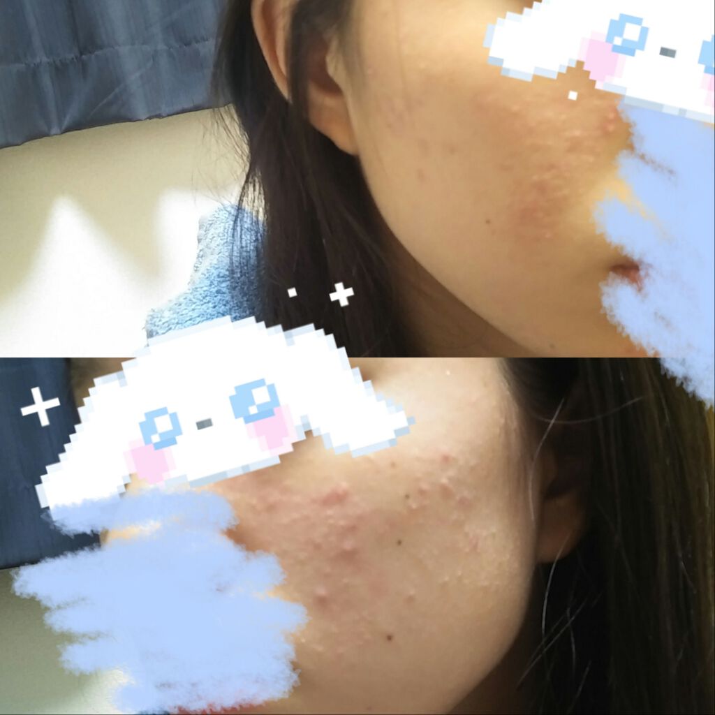 ma* on LIPS 「初めまして🙇🏻♀️汚らしい写真すみません🙏🏻私のお肌の現状で..」(1枚目)