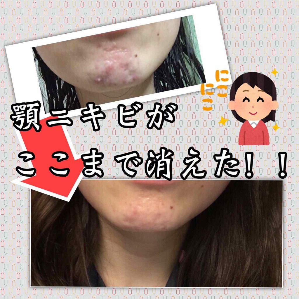 ピンプルクリア/IPSA/美容液を使ったクチコミ(1枚目)