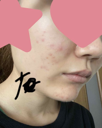 クリアトライアルセット M(しっとりタイプ)/オルビス/トライアルキットを使ったクチコミ(1枚目)