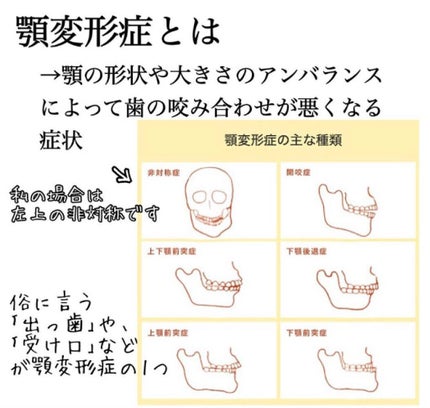 ぽむ on LIPS 「歯列矯正についてお話します!!私は一昨年の10月から歯列矯正を..」(4枚目)