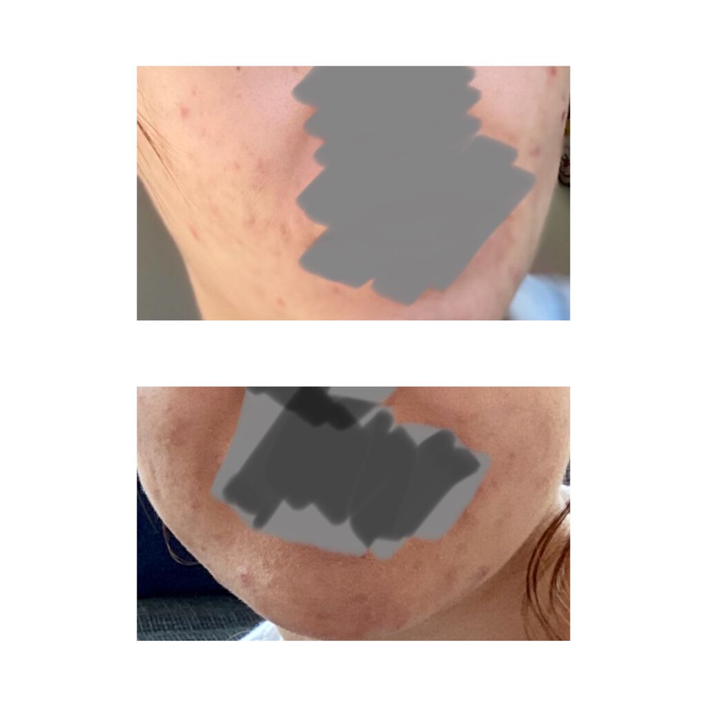 白潤プレミアム 薬用浸透美白化粧水しっとり/肌ラボ/化粧水を使ったクチコミ（2枚目）