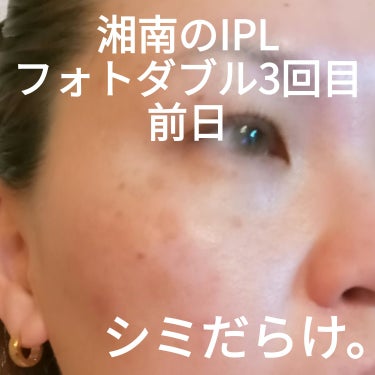 ビヨンセ奥二重向上委員長🥸LIPSパートナー🥳 on LIPS 「明日は施術3回目。前日なので記録用👍まだまだシミはありますがフ..」（1枚目）