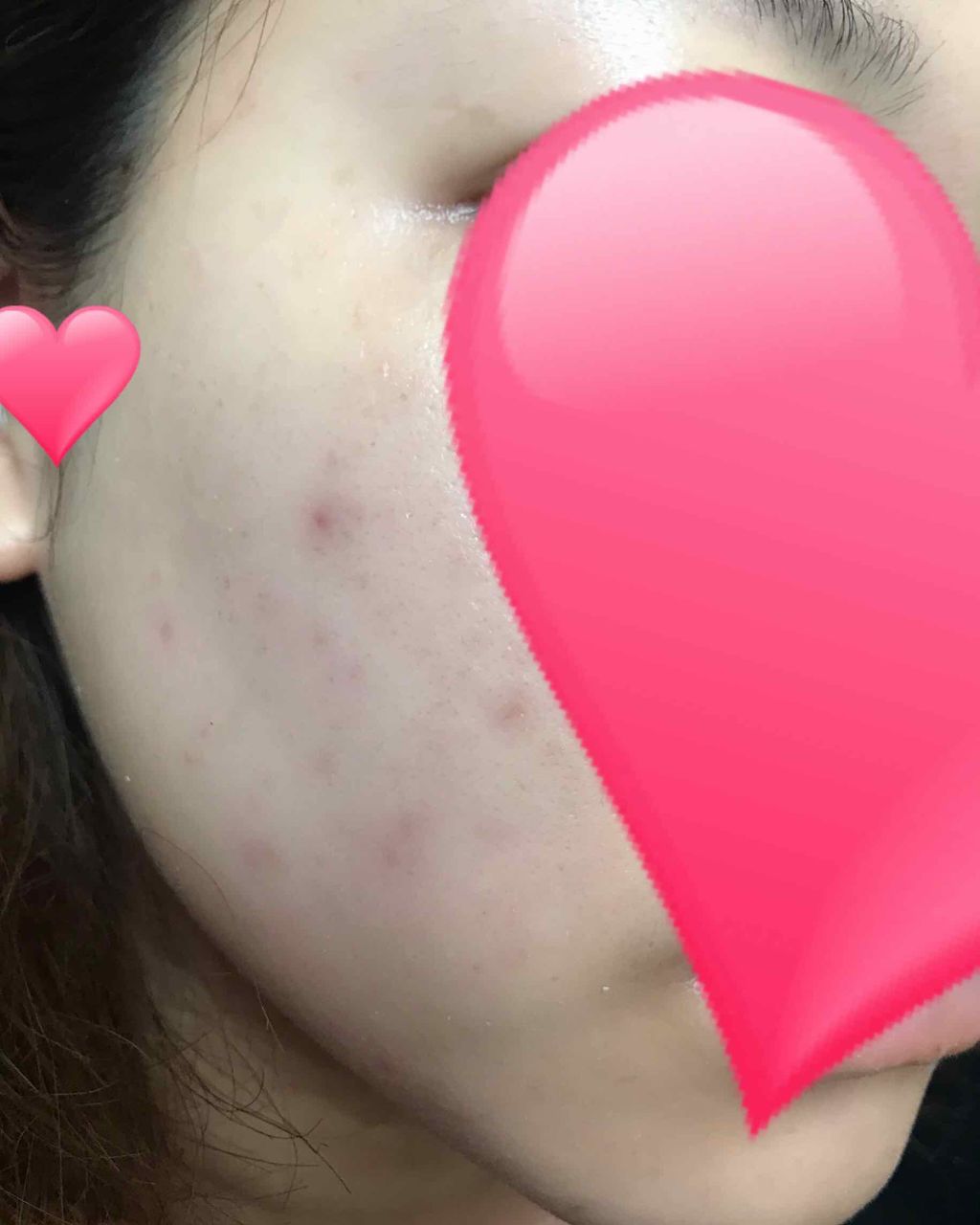 ハンガー on LIPS 「ヒルドイドローション0.3%50gを評価しました。ディフェリン..」(2枚目)