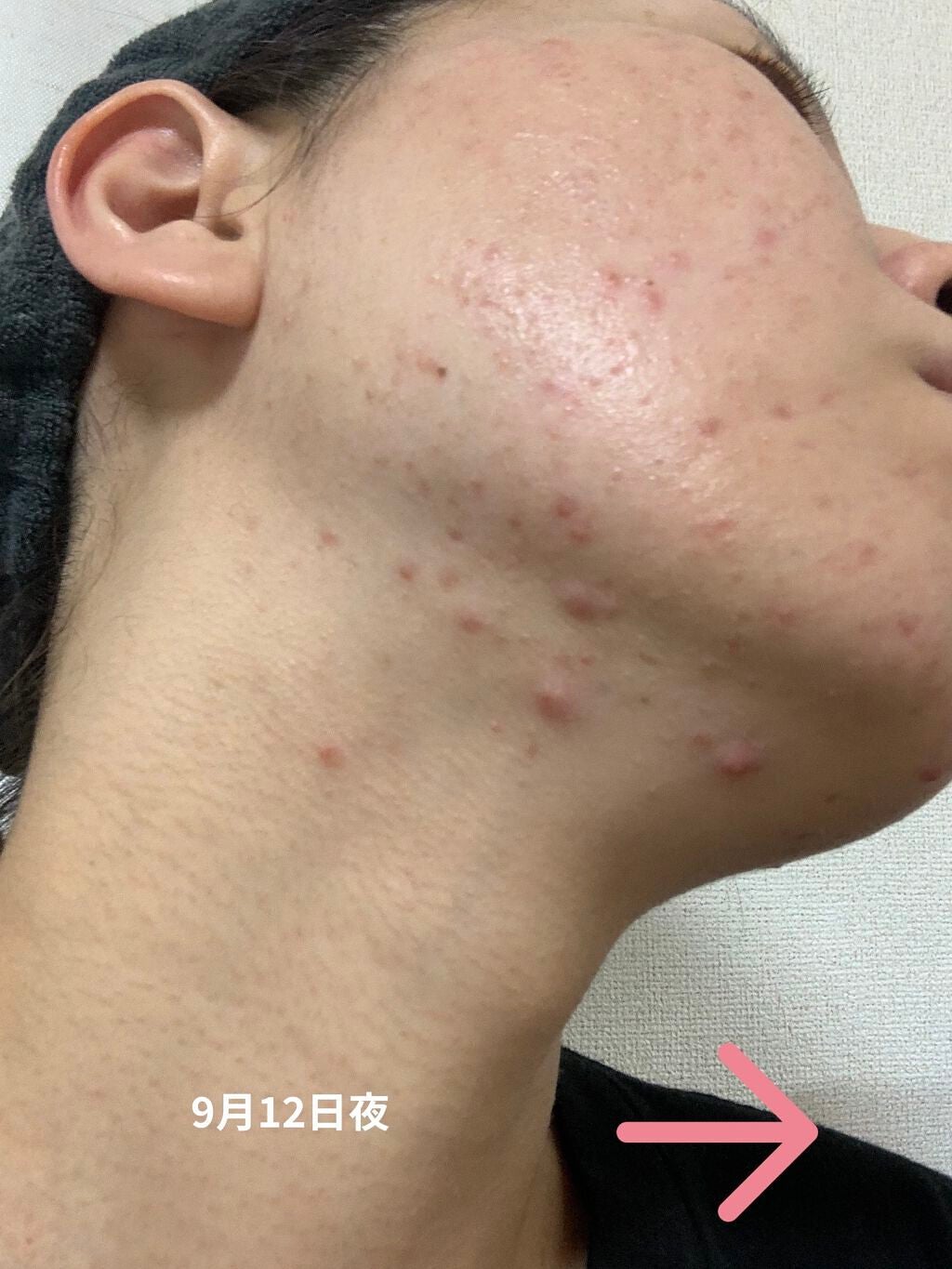 薬用 しみ 集中対策 美容液/メラノCC/美容液を使ったクチコミ(9枚目)