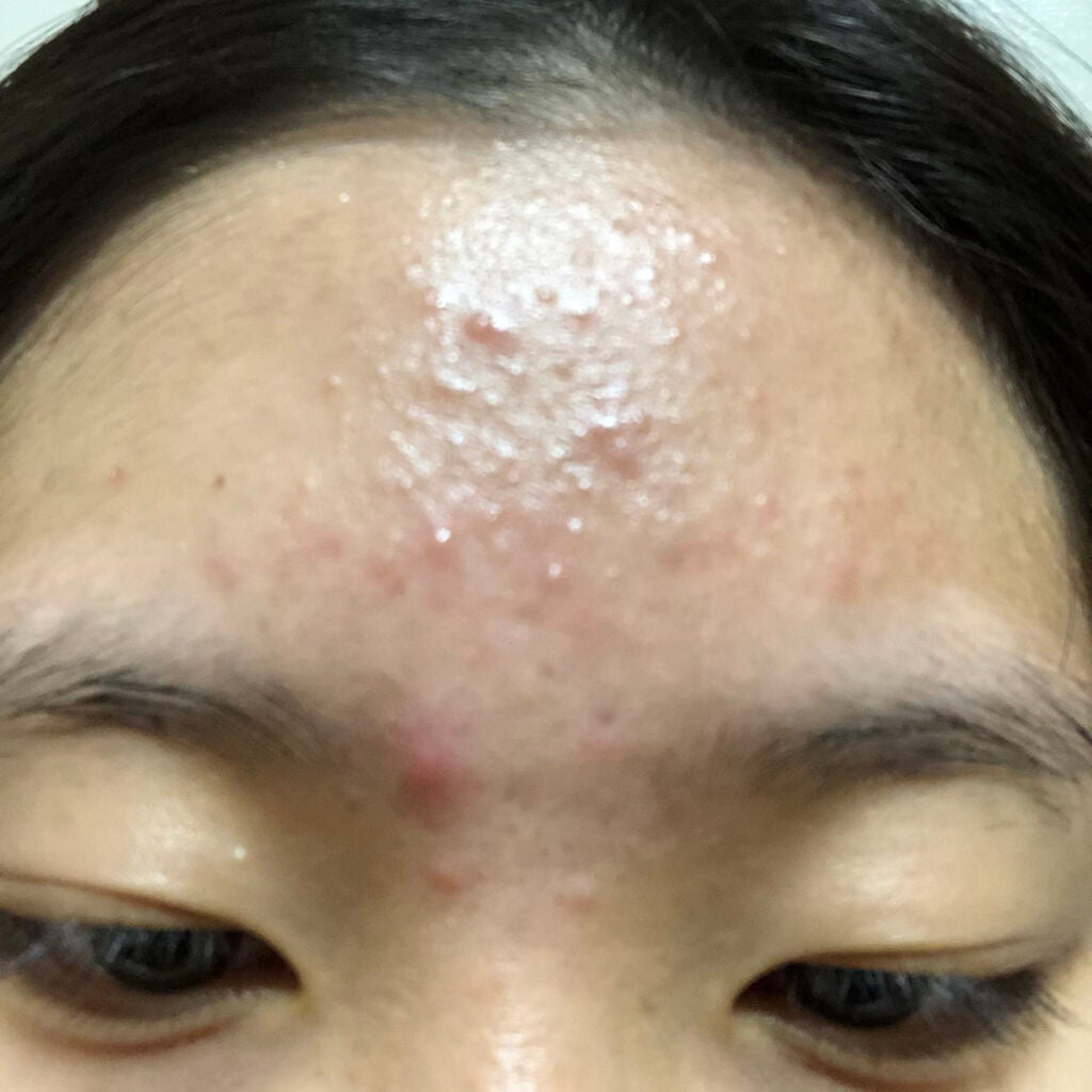 肌荒れとおさらば on LIPS 「16日目です❤️❤️これは、、、、肌が綺麗になっているのは??..」(3枚目)