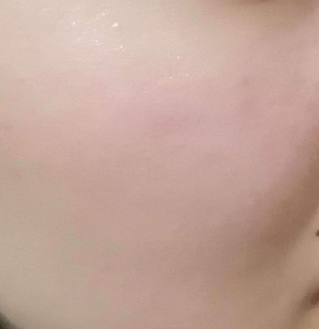 メディカルクリームc(医薬品)/メンソレータム アクネス25/その他を使ったクチコミ(2枚目)