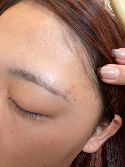 たそ on LIPS 「⚠️閲覧注意⚠️流行りのダーマペン4を施術しに行きます!(とい..」(6枚目)