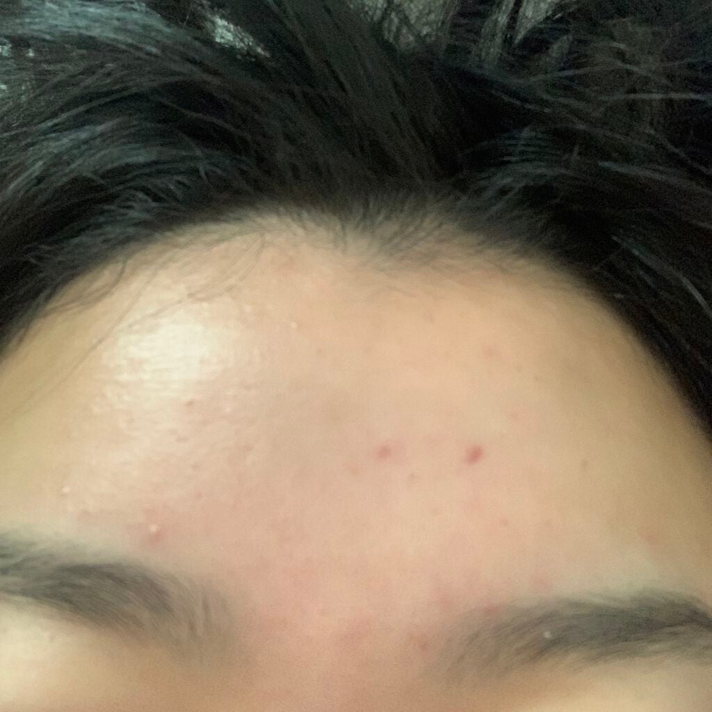 space on LIPS 「ほんまに薄くなってきたなあ!と感じるこの頃!新しいニキビも出に..」(3枚目)