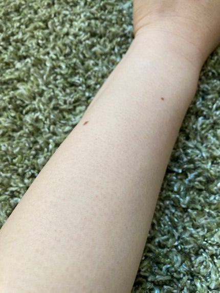 アイスレディ/icelady/家庭用脱毛器を使ったクチコミ(5枚目)