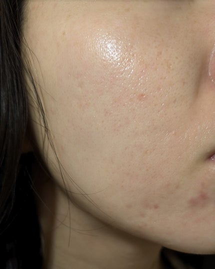 miina@汚肌工事録⚠️ on LIPS 「10/25の#汚肌工事録砂糖は摂らないようにしていますが、たま..」(1枚目)