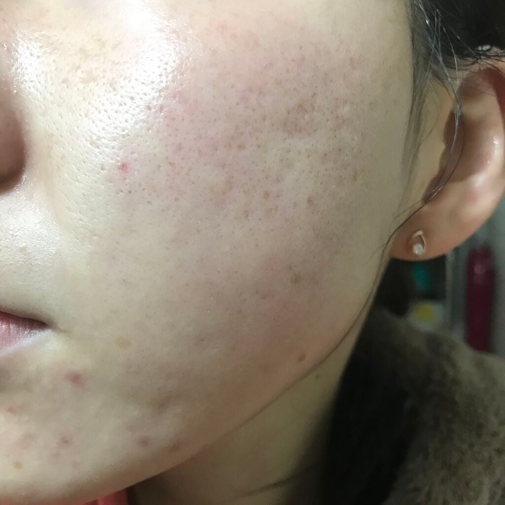 ティーツリーケア ソリューション エッセンシャルマスクEX/MEDIHEAL/シートマスク・パックを使ったクチコミ(2枚目)