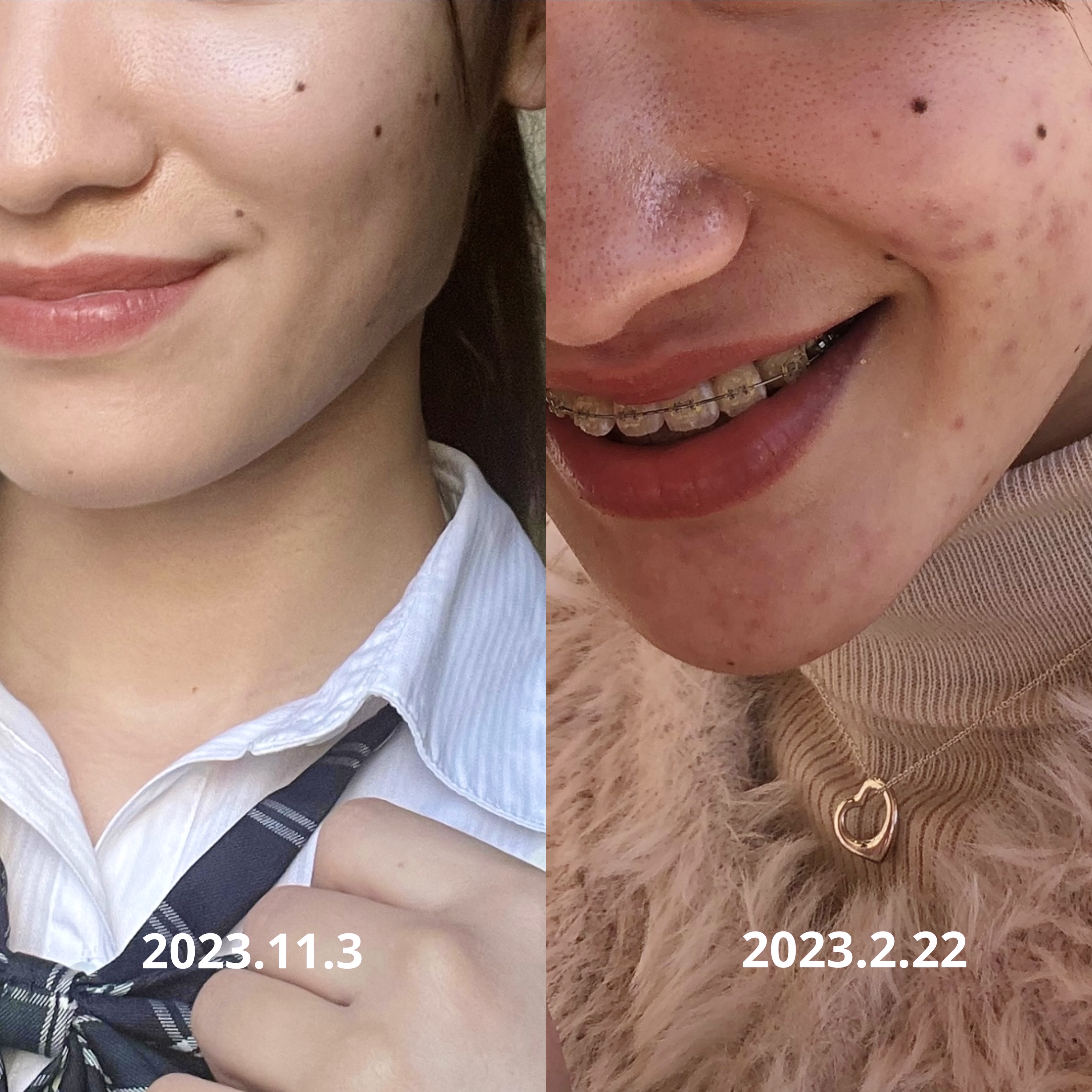 クラリファイング ローション 2/CLINIQUE/拭き取り化粧水を使ったクチコミ（2枚目）