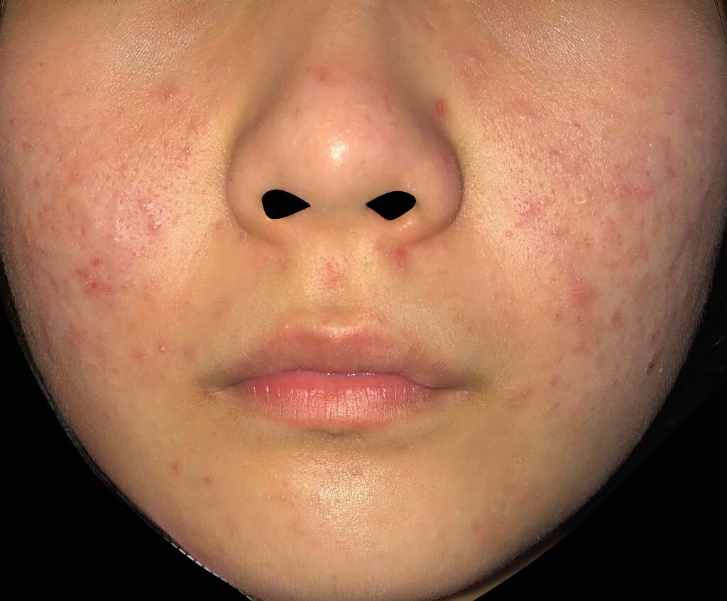 ちゅんはろ on LIPS 「過去で一番ヤバイですね。思春期ニキビなんですけどいい薬あります..」(2枚目)