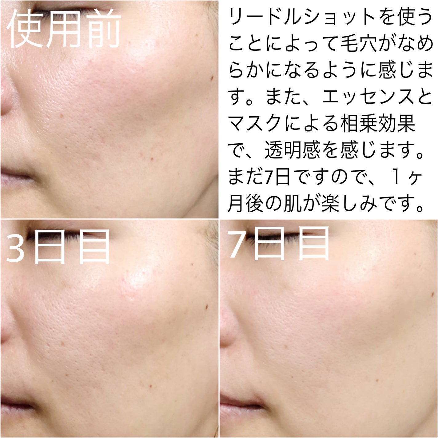 リードルショット100/VT/美容液を使ったクチコミ(5枚目)