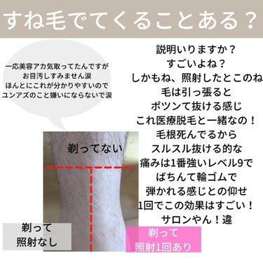 光脱毛器 VIO/Sarlisi/家庭用脱毛器を使ったクチコミ（5枚目）