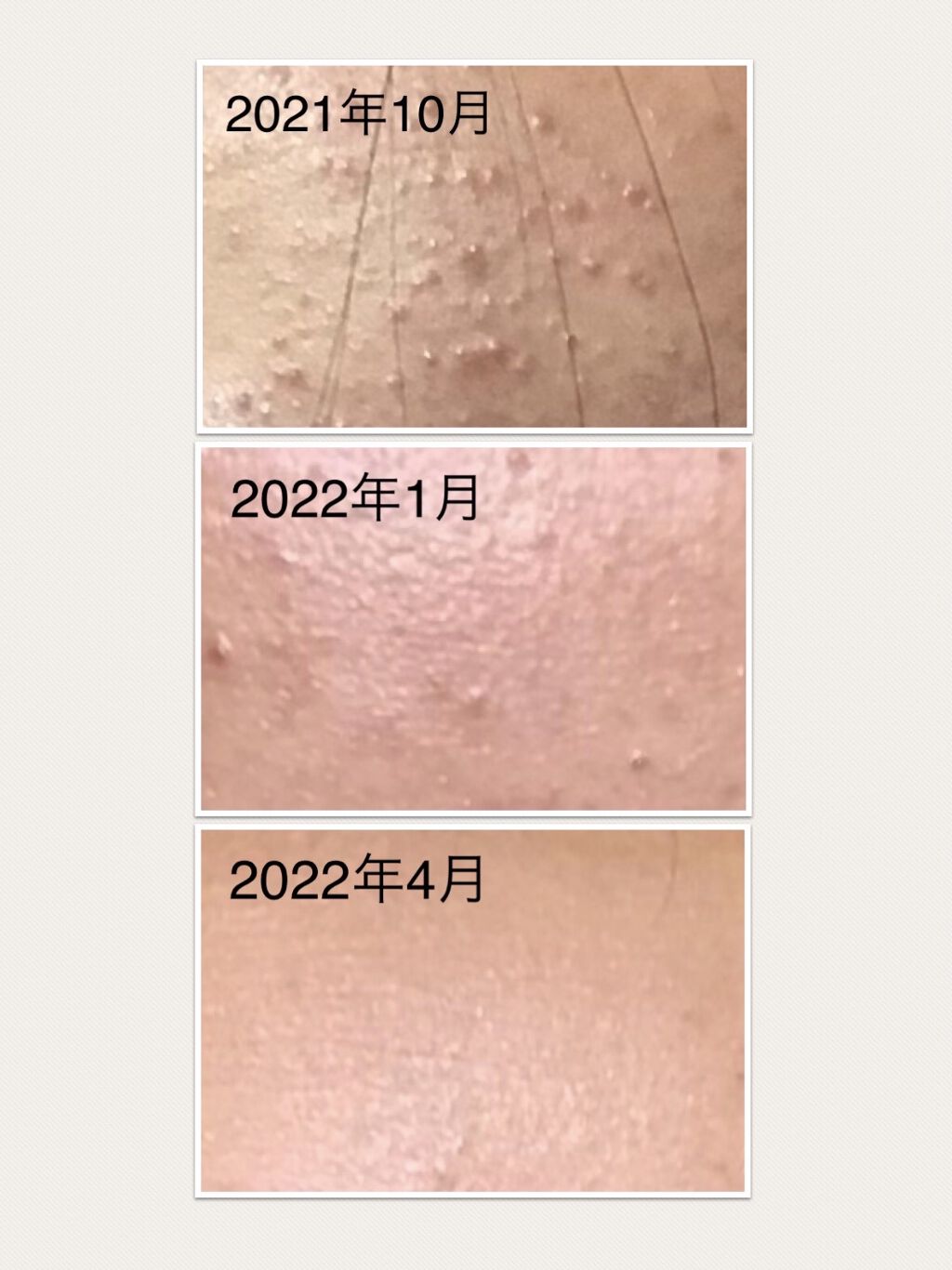 A アクネフォーム/NOV/洗顔フォームを使ったクチコミ（2枚目）