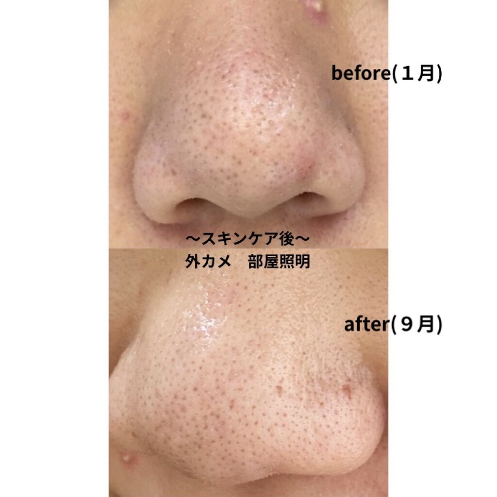 薬用 しみ 集中対策 美容液/メラノCC/美容液を使ったクチコミ（3枚目）