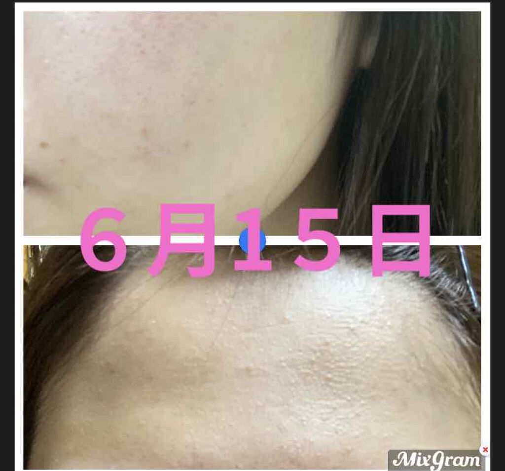 オードムーゲ 薬用ローション(ふきとり化粧水)/オードムーゲ/拭き取り化粧水を使ったクチコミ(3枚目)