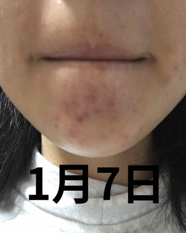 fresh_make_pac on LIPS 「大人ニキビにずっと悩んできて皮膚科に相談して、いろいろ試した結..」（1枚目）