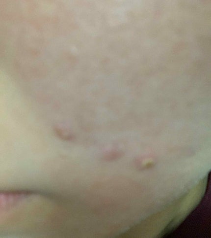sou on LIPS 「エピデュオゲルの副作用すごくて、皮剥けたり、ヒリヒリするけど、..」(1枚目)
