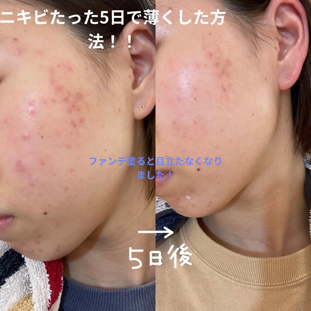 sparkle_glow_uul on LIPS 「月に1回ニキビ大量発生してしまう主に乾燥肌。Tゾーンは油っぽい..」(1枚目)