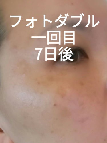 ビヨンセ奥二重向上委員長🥸LIPSパートナー🥳 on LIPS 「フォトダブル施術前、一回目の7日後、2回目の7日後の経過です。..」（2枚目）