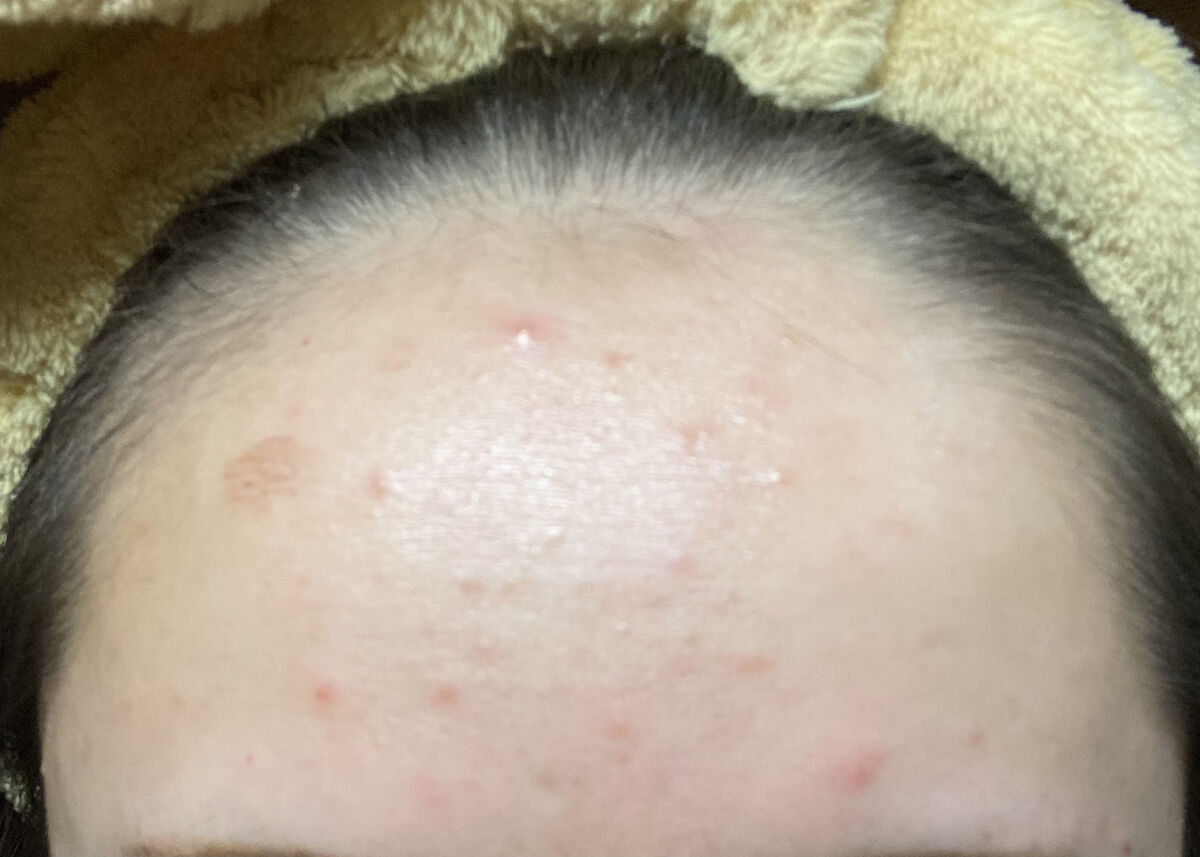 薬用しみ対策 美白化粧水/メラノCC/化粧水を使ったクチコミ（3枚目）