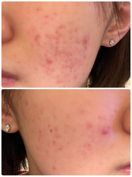 白潤プレミアム薬用浸透美白化粧水/肌ラボ/化粧水を使ったクチコミ(2枚目)