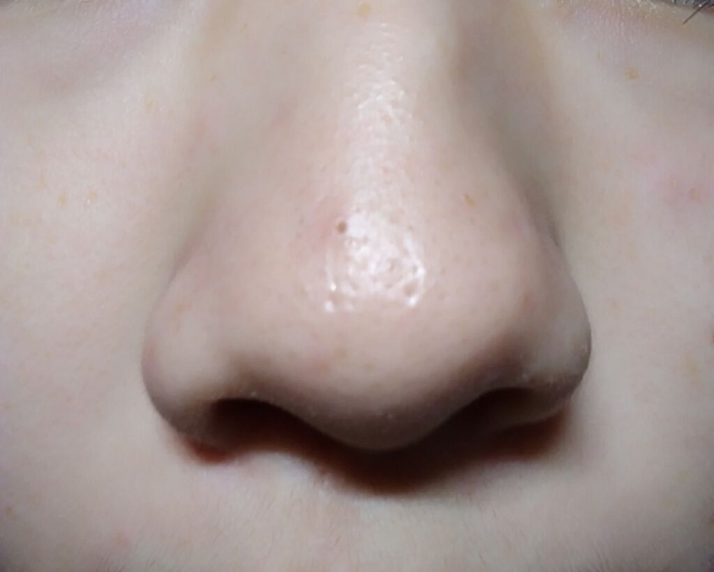 は る か on LIPS 「助けてください…😭思春期ニキビTゾーンの白ニキビ(たまに赤ニキ..」(2枚目)