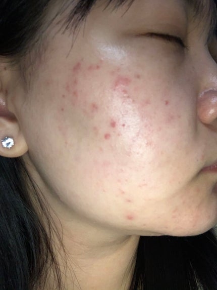 ティーツリーケア ソリューション エッセンシャルマスクEX/MEDIHEAL/シートマスク・パックを使ったクチコミ(2枚目)