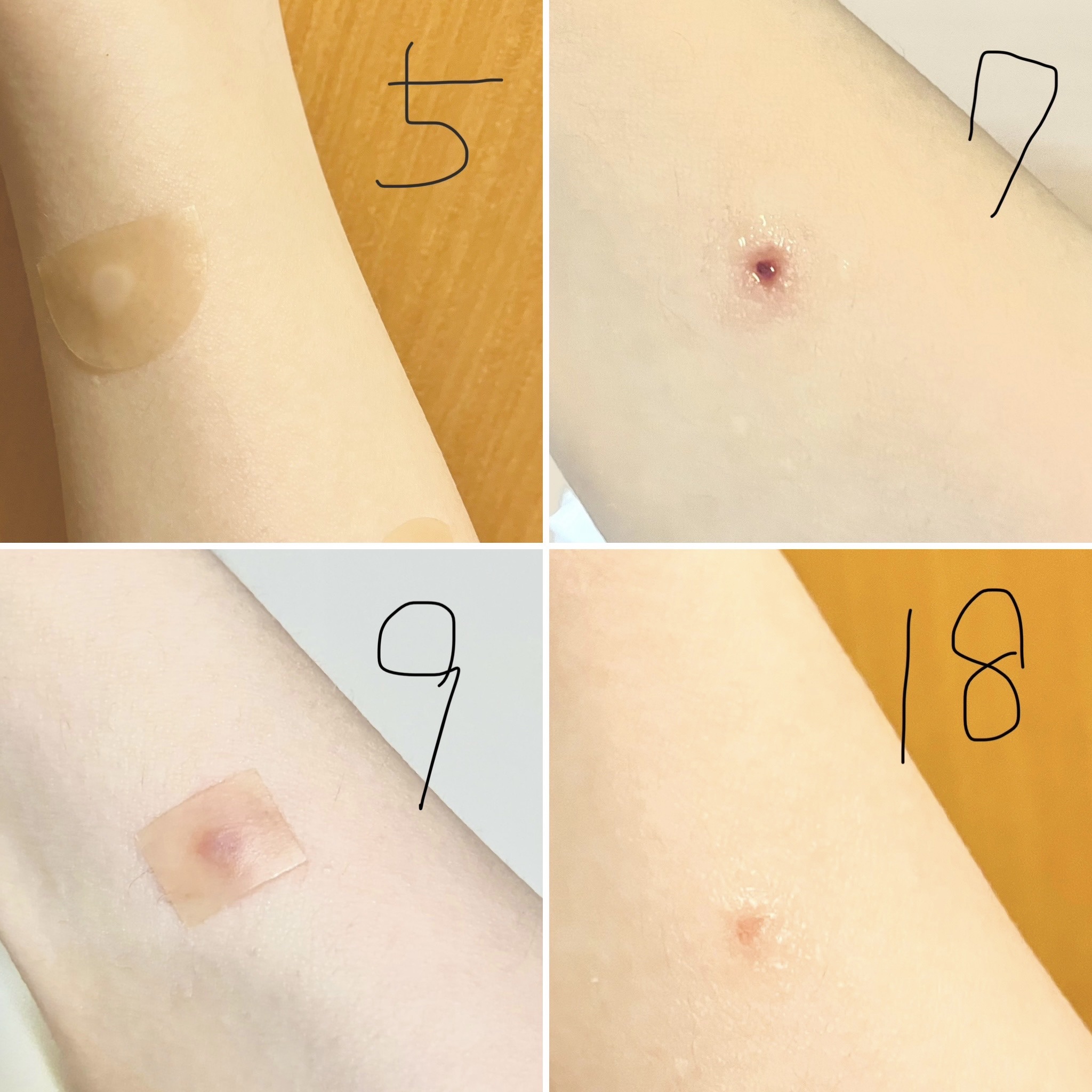 ハイドロコロイドパッド厚型 普通/matsukiyo/その他を使ったクチコミ（2枚目）