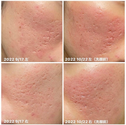 ダーマペン・ダーマスタンプ/MyM/その他スキンケアグッズを使ったクチコミ(1枚目)