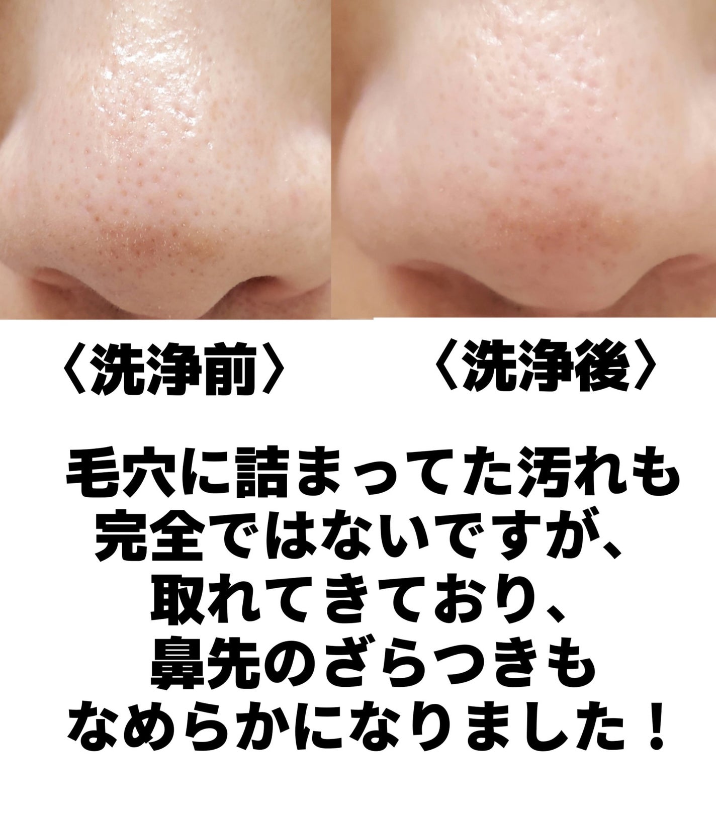 エクストラ スーパー9プラス アクティブ スティック/MEDIPEEL/ピーリングを使ったクチコミ(3枚目)