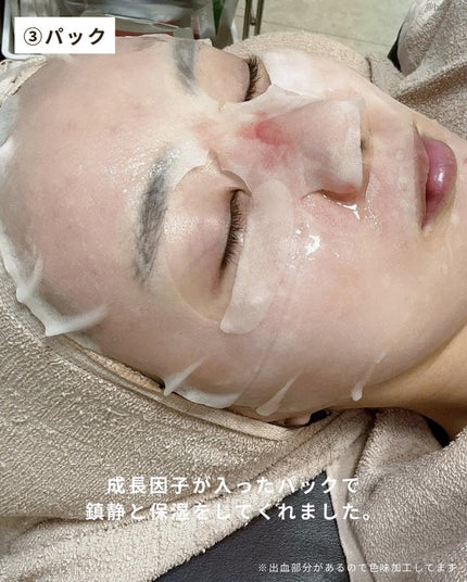 haruka  -韓国コスメ- on LIPS 「◀最新の投稿も見る────────先月初めてダーマペンを受けて..」(4枚目)