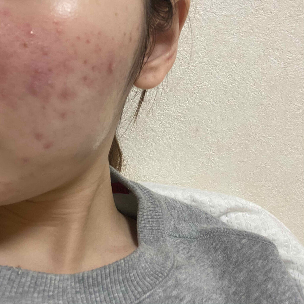 クリンダマイシンゲル(医薬品)/クラシエ薬品/その他を使ったクチコミ（2枚目）