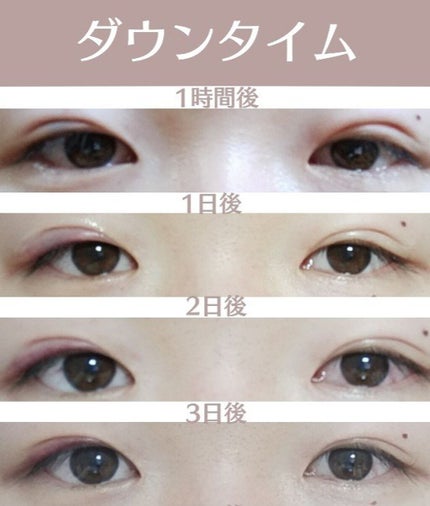 LOUJENE LJ メッシュシートでこっそりふたえのクチコミ「前回の投稿にはたくさんのいいねありがとうございました!
※2ページから整形前の目の写真で.....」(2枚目)